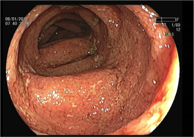 Día de la Enfermedad Inflamatoria Intestinal: vigilancia de factores genéticos y ambientales